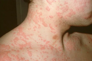 skin-disease