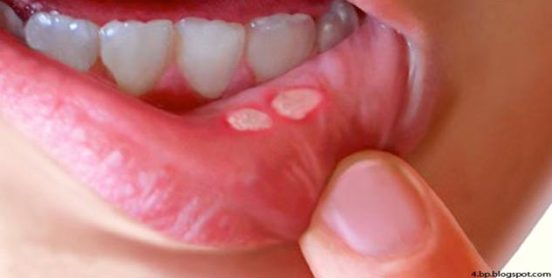 mouth-ulcer-in-hindi-1-633x319
